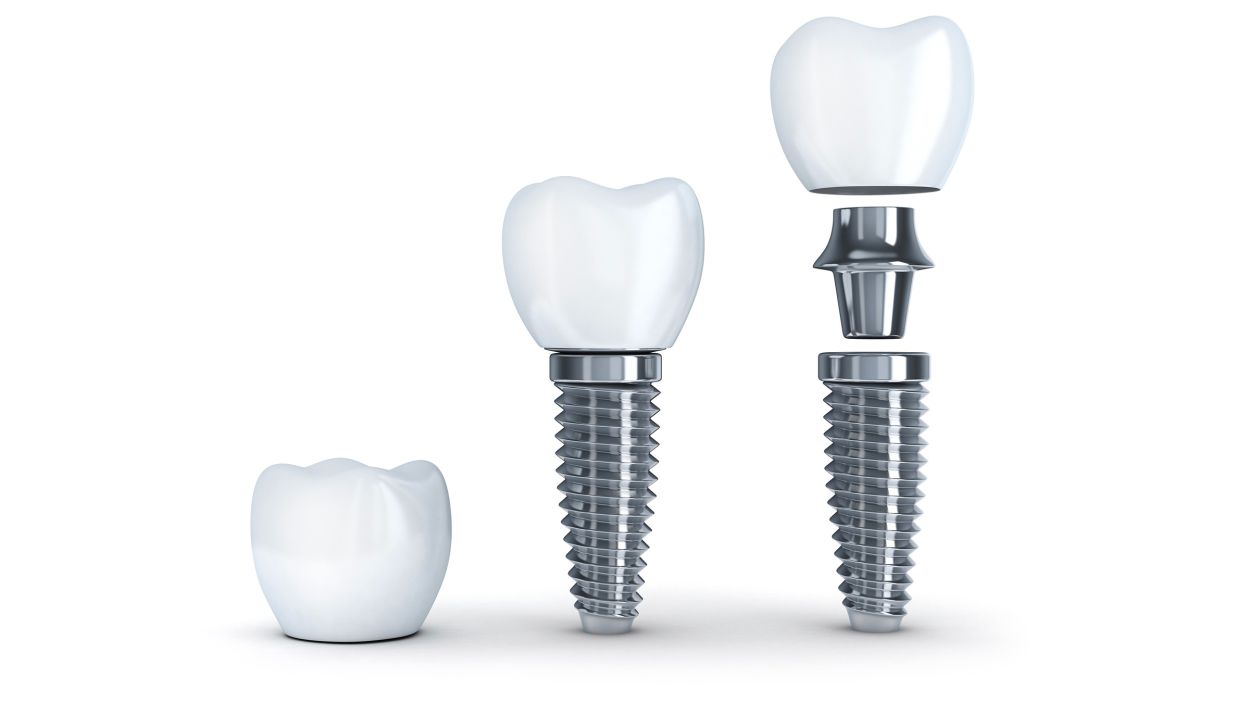 dental implant