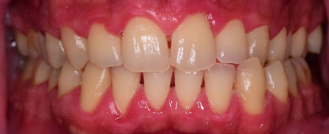 Gum Disease Clean After