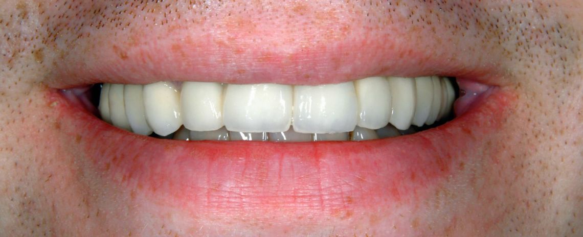 Implant Denture After