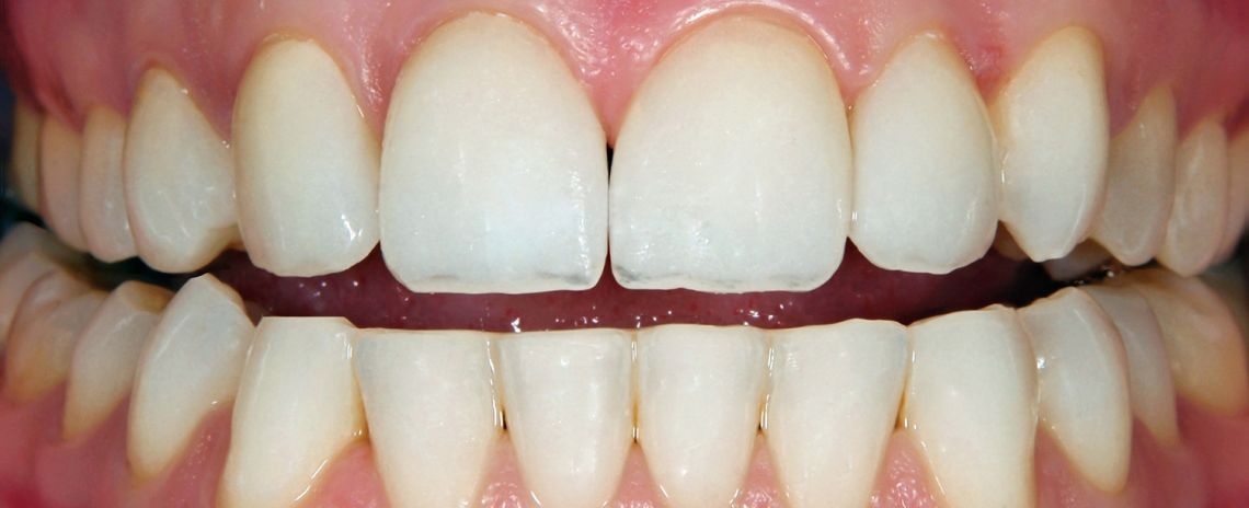  Teeth Straightening and Whitening After