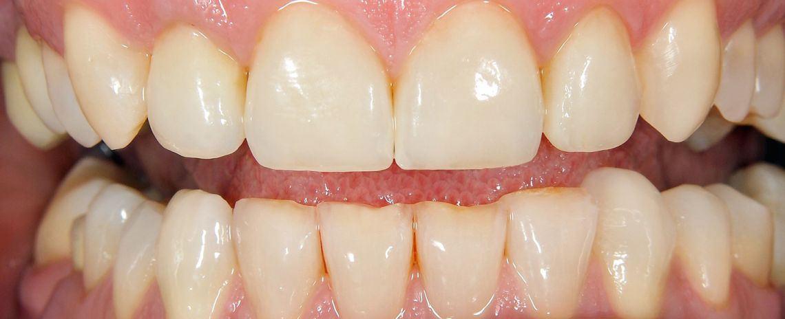  Composite Bonding and Whitening After