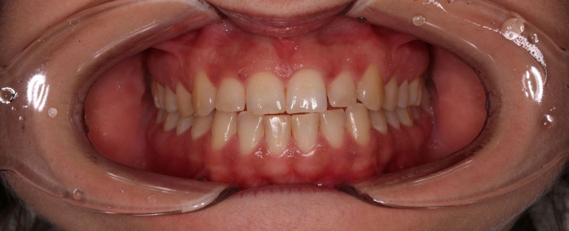 Invisalign Before