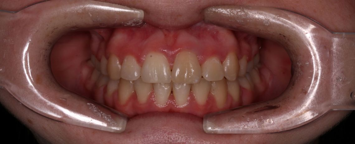 Fixed Braces After