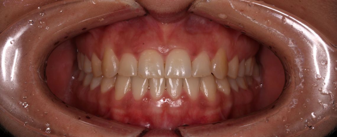  Invisalign After