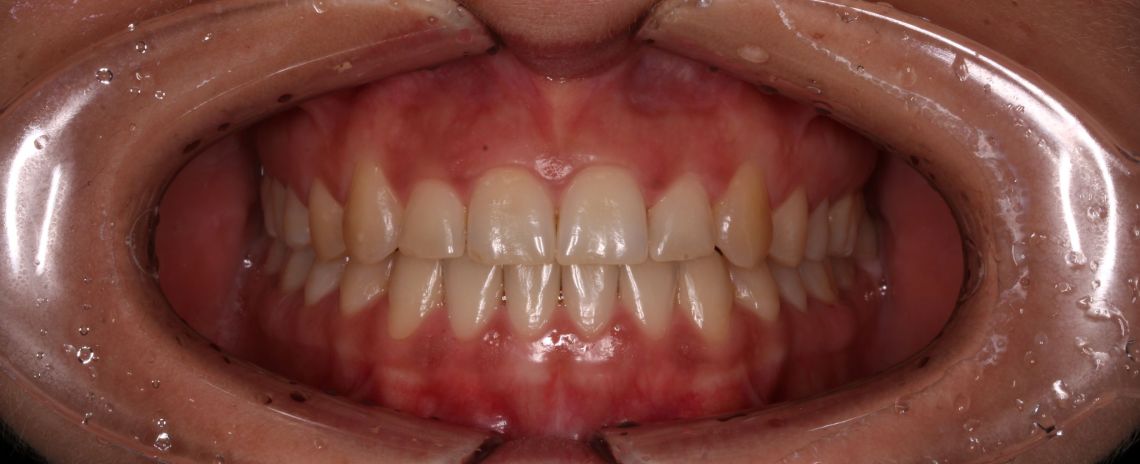 Invisalign After