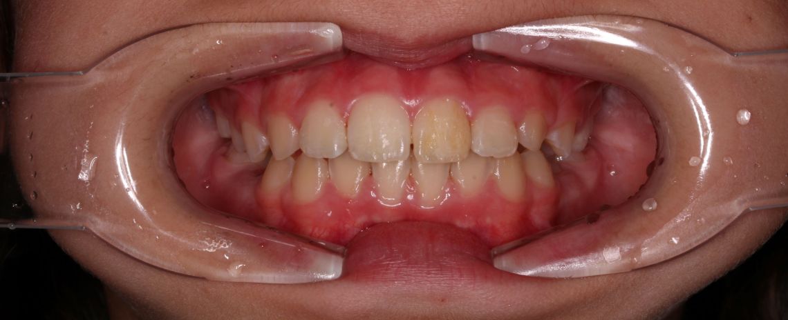 Fixed Braces After