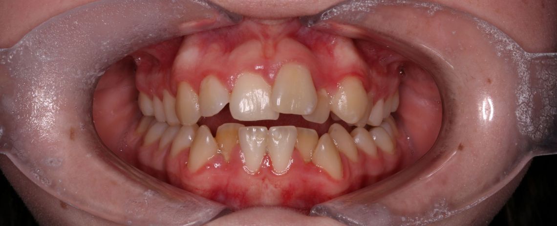Fixed Braces Before