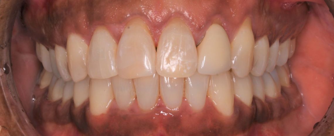 Invisalign After