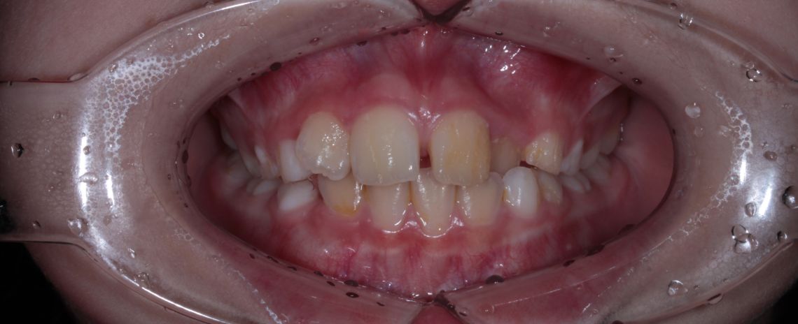 Fixed Braces Before