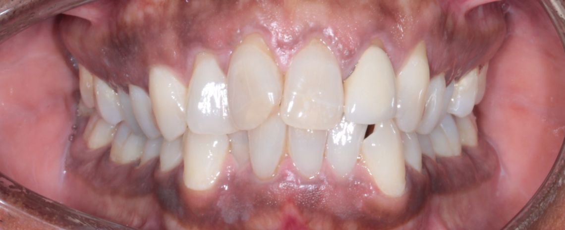 Invisalign Before