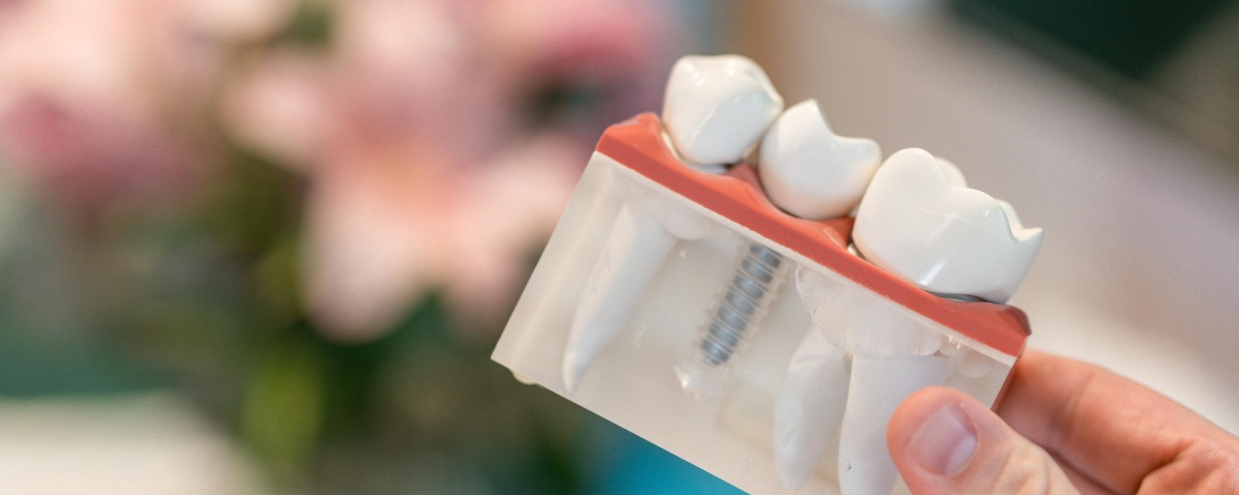 Dental implants